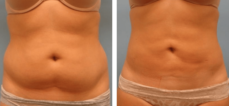 Liposuction