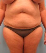 Tummy Tuck