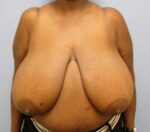 Breast Reduction