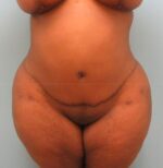 Tummy Tuck