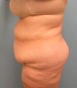 Tummy Tuck