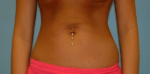 Liposuction