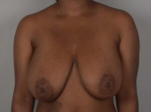 Breast Reduction
