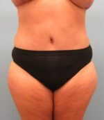 Tummy Tuck