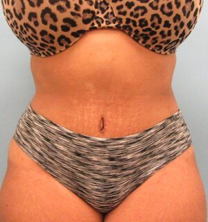 Tummy Tuck