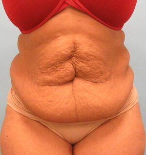 Tummy Tuck