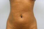 Liposuction