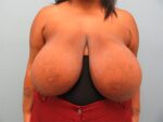 Breast Reduction