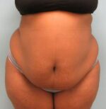 Tummy Tuck