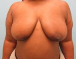 Breast Lift
