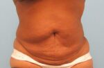 Tummy Tuck