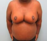 Breast Reduction
