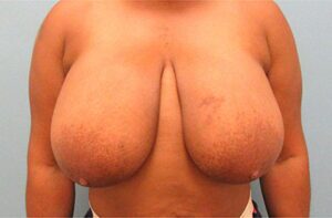 Breast Reduction