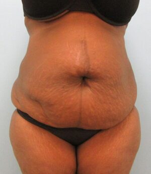 Tummy Tuck