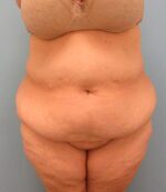 Tummy Tuck