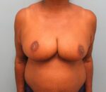 Breast Reduction