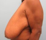 Breast Reduction