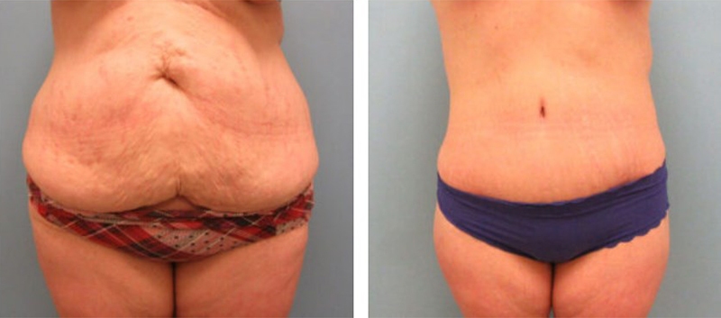 Abdominoplasty Results