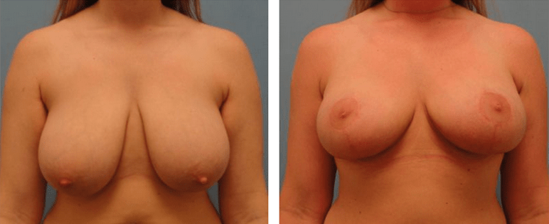 Before and After photo of Breast Lift Surgery