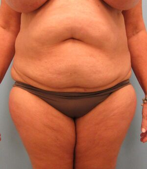Tummy Tuck