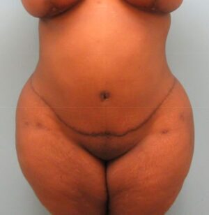 Tummy Tuck