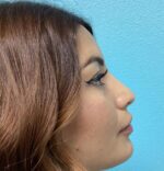 Rhinoplasty