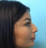 Rhinoplasty